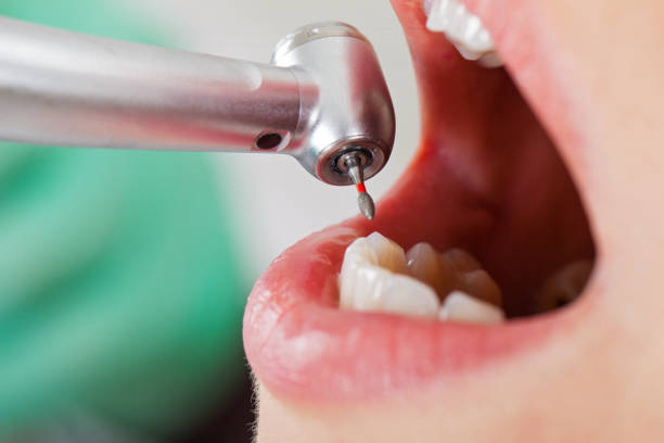 Best Emergency Dentist for Lost Fillings or Crowns in Dike, IA